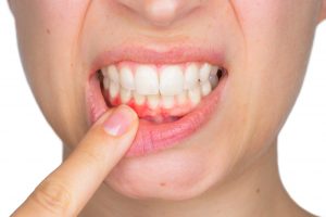 do teeth whitening strips harm enamel
