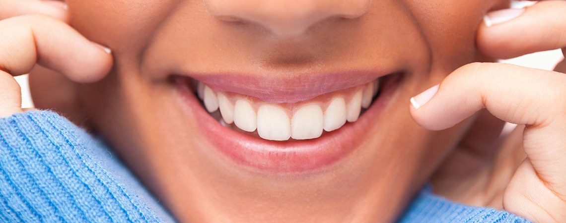 dental veneers naperville