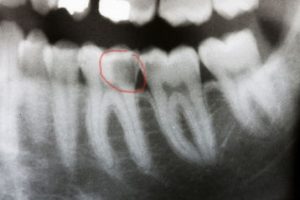 decay tooth death