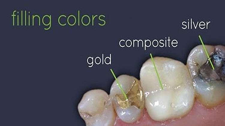 Filling Options For Cavities