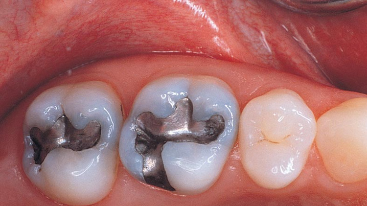 Composite vs Silver Dental Filling