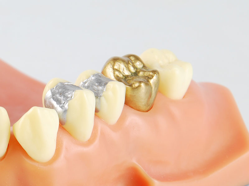 Filling Options For Cavities