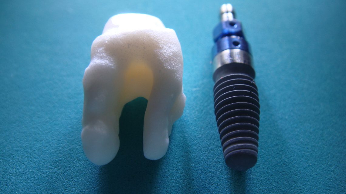 Dental implant 1