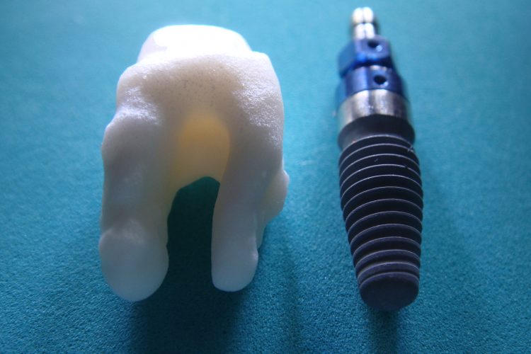 Dental implant 1