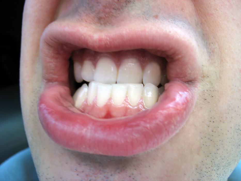 Risk factors for bruxism, teeth grinding