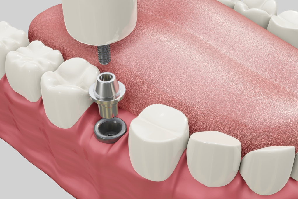 Bridges vs. Dental Implants